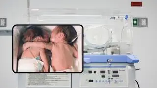 3-tygodniowa dziewczynka przeżyła dzięki siostrze bliźniaczce