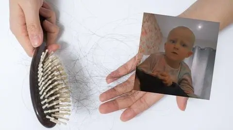 Cierpi na łysienie plackowate 