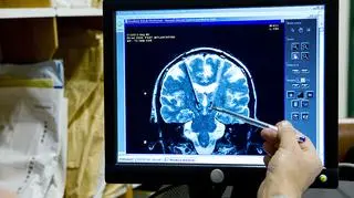 Zmiany zachodzące w mózgu otyłych są podobne do tych u osób z Alzheimerem. Co pokazały nowe badania?