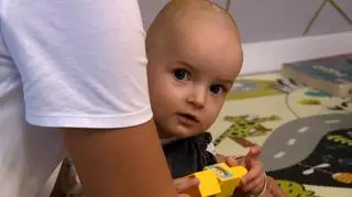 Nowatorskie operacje zmieniające kształt głowy niemowląt 