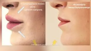 Moda na naturalne usta 