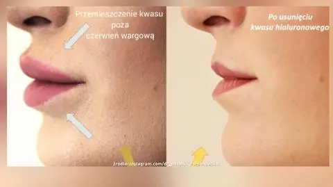 Moda na naturalne usta 