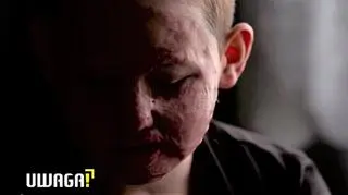 10-letni Tomek omal nie spłonął w aucie. "Jak z niego wyszedł, skóra mu wisiała"
