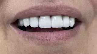 Proteza zębów 