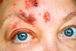 Dermatillomania