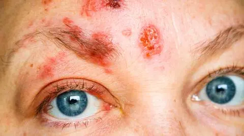 Dermatillomania