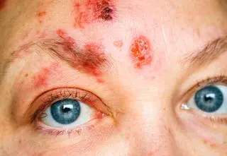 Jak wygląda życie osoby cierpiącej na dermatillomanię? "Aby zwyciężyć w tej grze, muszę oszukać swój rozum"