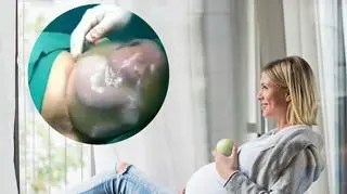 "Łagodna cesarka to przełom". Zobacz, jak wygląda połączenie porodu i zabiegu