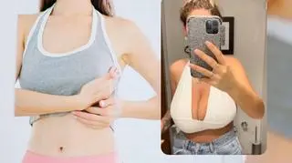 Gigantyczny biust od lat rujnował jej życie. W końcu zdecydowała się na operację. "Moje piersi sięgały brzucha"