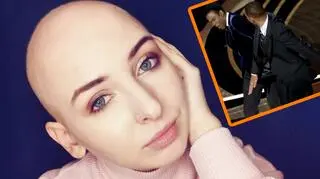 "Kiedyś wychodziłam z płaczem". ŁysOla oswaja temat łysienia plackowatego