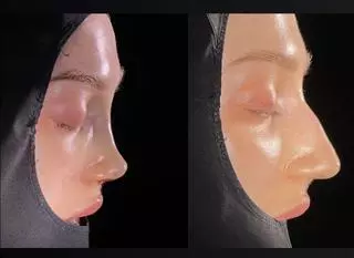 Nos po zabiegu i przed operacją