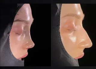 Nos po zabiegu i przed operacją