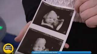 Dziecko Wiktorii było operowane w jej łonie: "Czułam ból, ale i radość, że z tą wadą można coś zrobić"