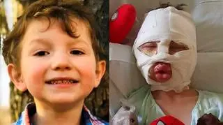 Kolega podpalił 6-letniego chłopca. "Będzie miał blizny na ciele i psychice do końca życia"