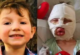 Kolega podpalił 6-letniego chłopca. "Będzie miał blizny na ciele i psychice do końca życia"