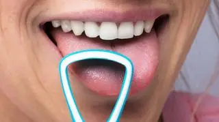 Biały nalot na języku - czym może być spowodowany? Kiedy udać się do lekarza?