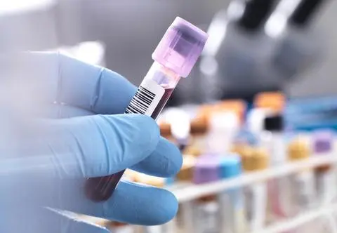 Trzymaj cholesterol w ryzach. Specjalista podpowiada, jak to zrobić