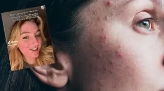 Filmy ukazujące jej walkę z trądzikiem uznano za makabryczne. TikTok zablokował konto 16-latki