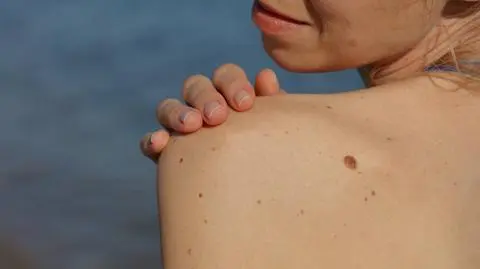 Jak rozpoznać czerniaka?