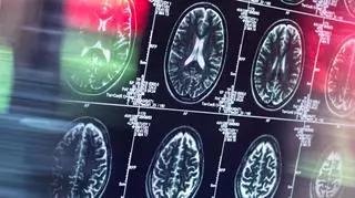Jaki jest prawdziwy wiek mózgu? Określić to pomoże sztuczna inteligencja. "Pozwala nam wykryć subtelne zmiany związane z demencją"
