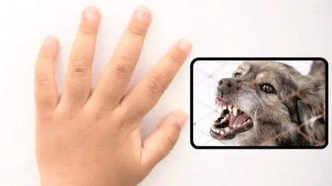 Katowice. Pies odgryzł palce dwulatkowi