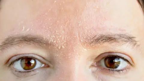 Psychodermatologia