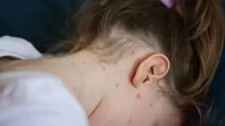 Ospa wietrzna - co to za choroba? Czym się różni od ospy prawdziwej