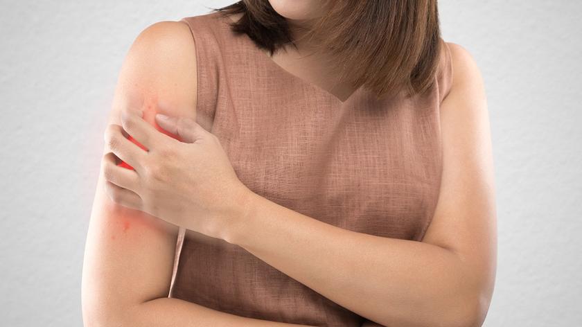 Kobieta z łuszczycą