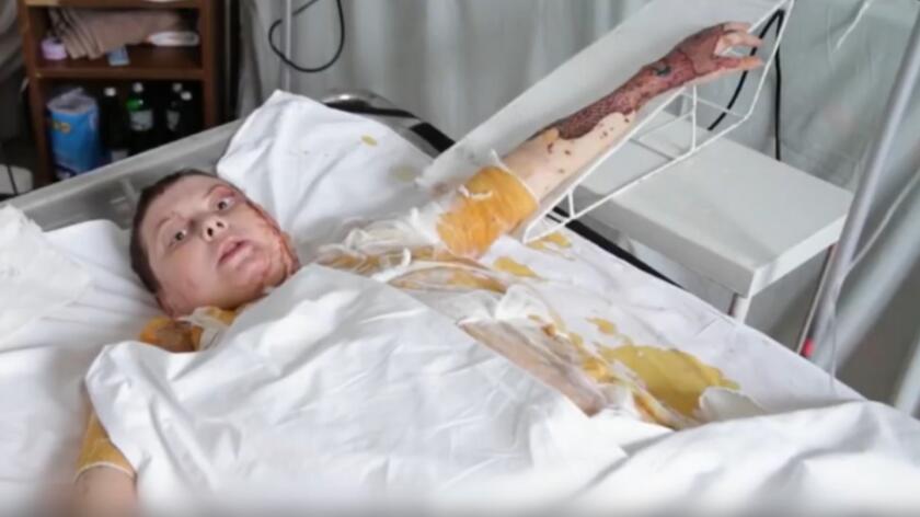 Katia Gandziuk poparzona na łóżku w szpitalu