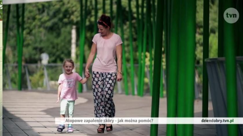 Atopowe zapalenie skóry