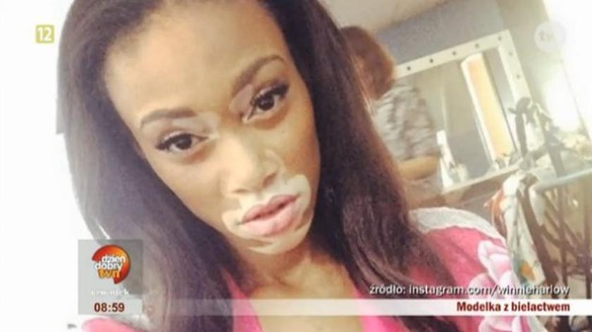 Winnie Harlow - modelka z bielactwem 