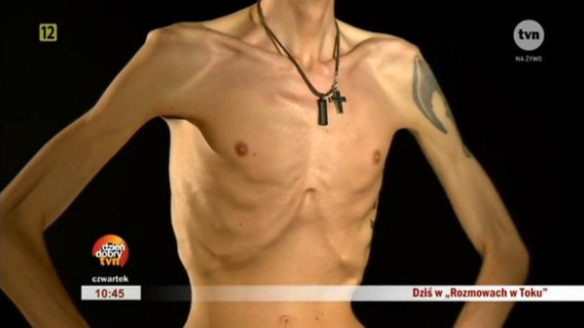 Anoreksja u mężczyzn