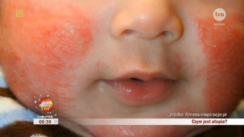 Atopowe zapalenie skóry