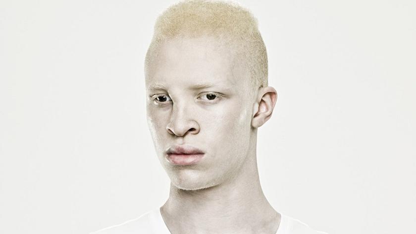 Albinos 