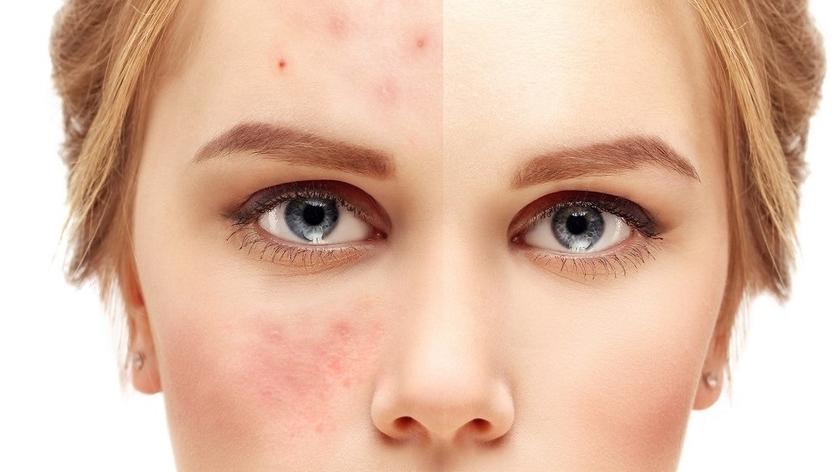 Plamy na twarzy