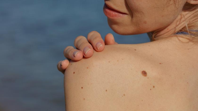 przebarwienia na skórze