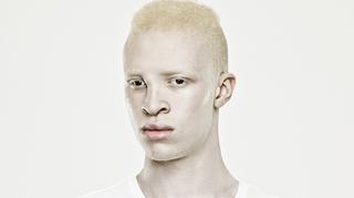 Porcelanowi ludzie, czyli jak żyje się z albinizmem?