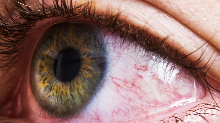 osoba, która ma zaczerwienione oczy 